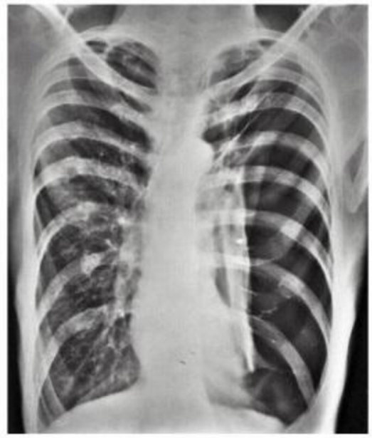 Lungs X ray